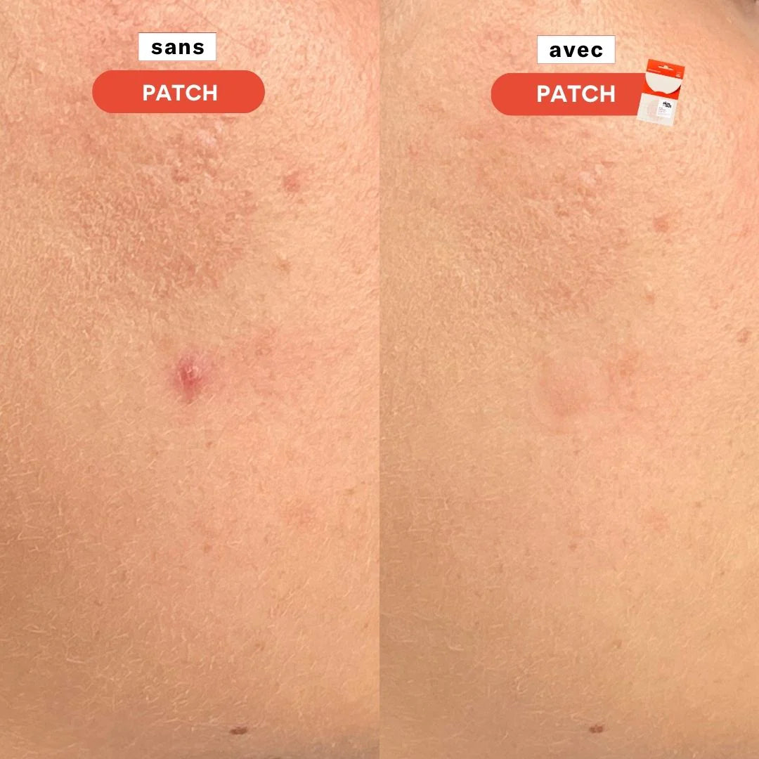 skin and out patchs boutons